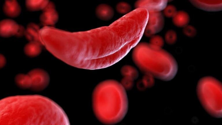 Tyrimo rezultatai rodo, kad žmonių, sergančių pjautuvine anemija, smegenys atrodo senesnės