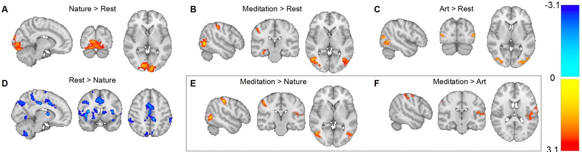 Neurovaizdavimas atskleidžia skirtingus smegenų aktyvacijos modelius