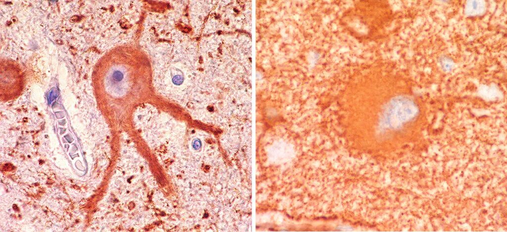 Brazilijos tyrėjai sukuria ląstelių atlasą smegenų apsigimimui, susijusiam su sunkia epilepsija