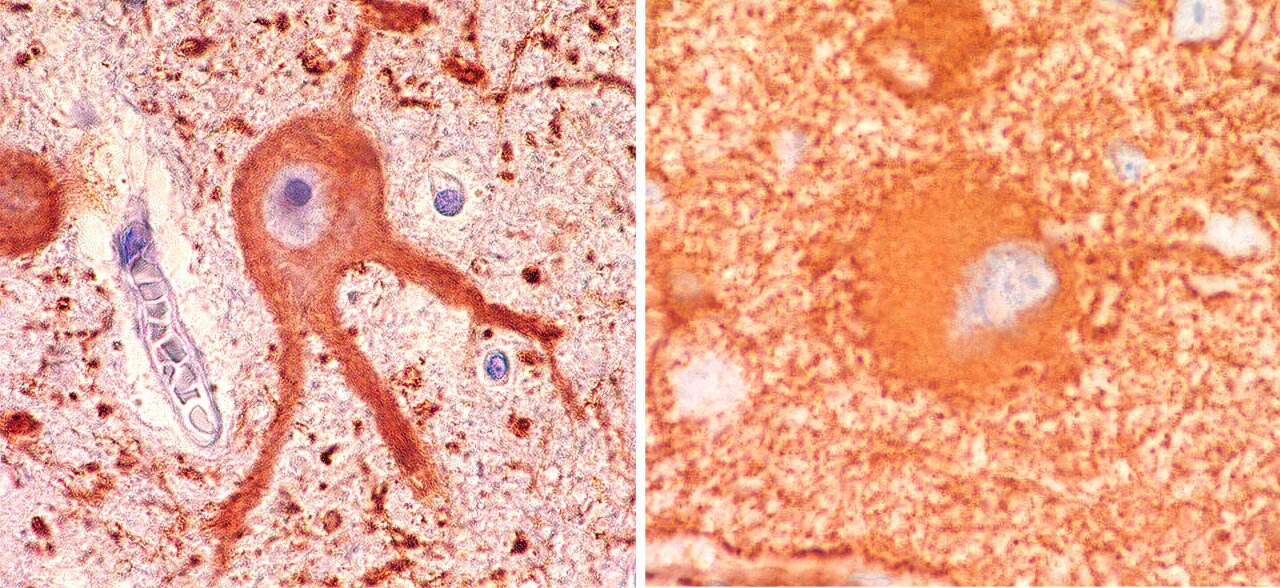 Brazilijos tyrėjai sukuria ląstelių atlasą smegenų apsigimimui, susijusiam su sunkia epilepsija