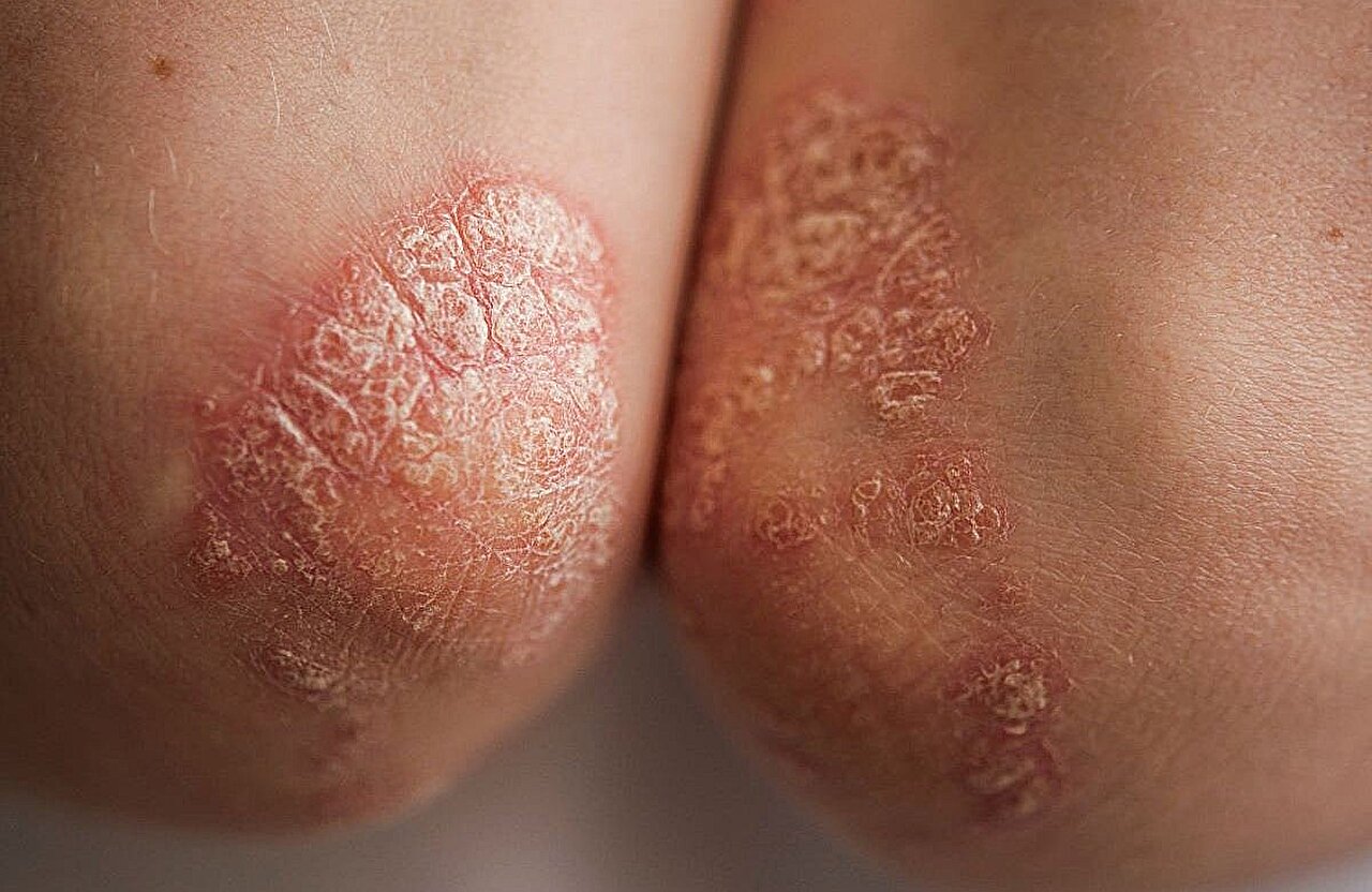 Realaus pasaulio tyrimas rodo ixekizumabo efektyvumą psoriazei
