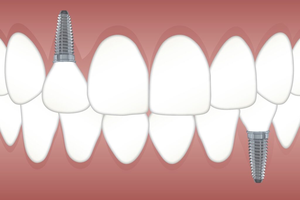 Ką žinoti anksčiau ir po to gauni dantų implantus