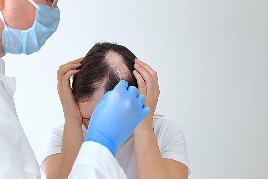 Ivarmacitinib 4 mg, 8 mg efektyvus suaugusiems, sergantiems sunkia alopecijos areata