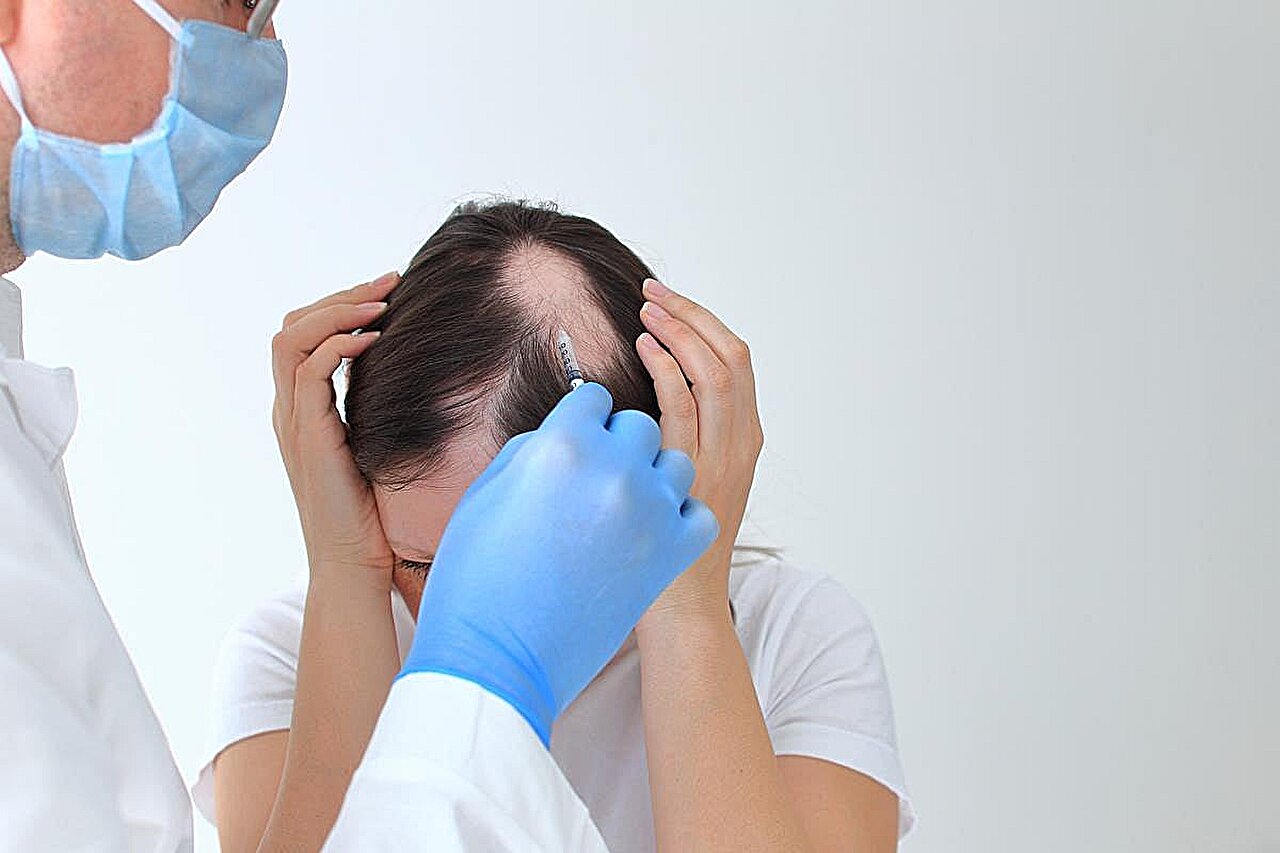 Ivarmacitinib 4 mg, 8 mg efektyvus suaugusiems, sergantiems sunkia alopecijos areata