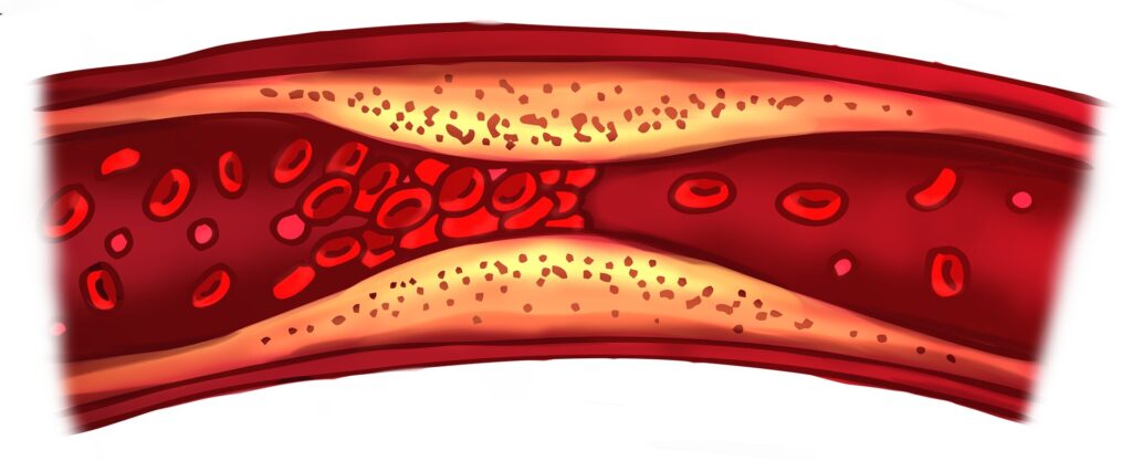 Tyrimai siūlo, kad tūkstančius gyvybių būtų galima išgelbėti derinant du cholesterolio kiekius mažinančius vaistus