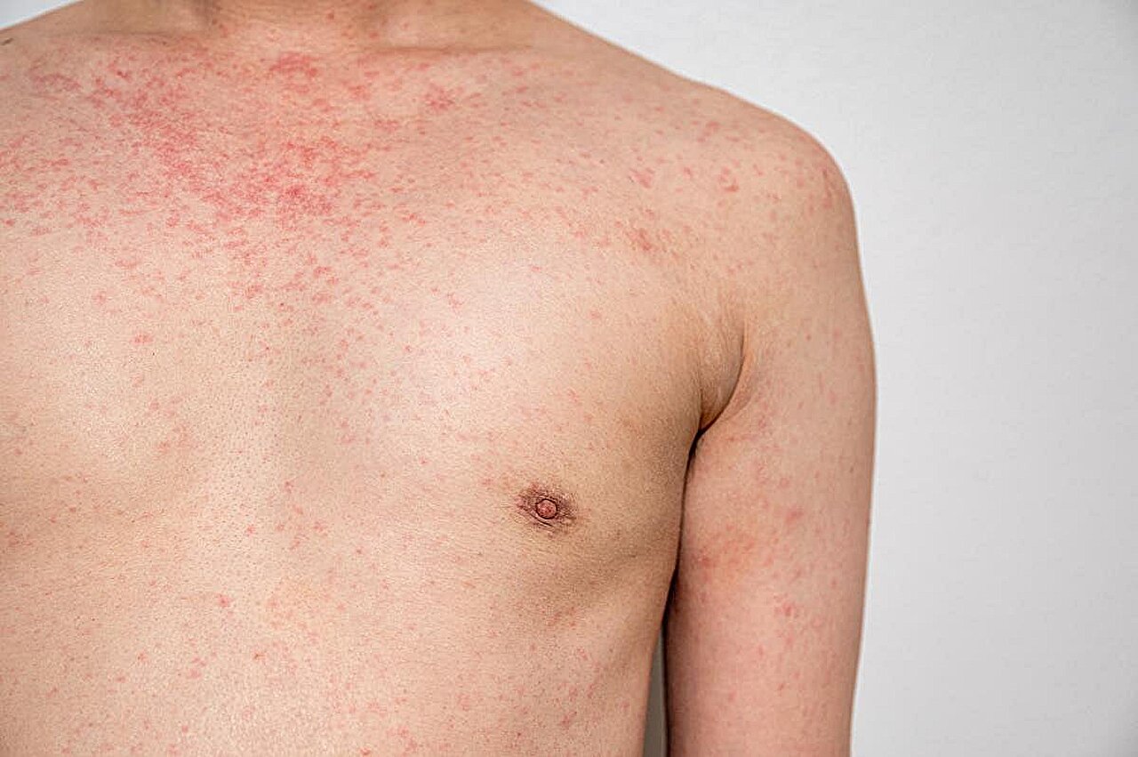 Tyrimų protrūkis sukelia pavojingą vitamino A toksiškumą