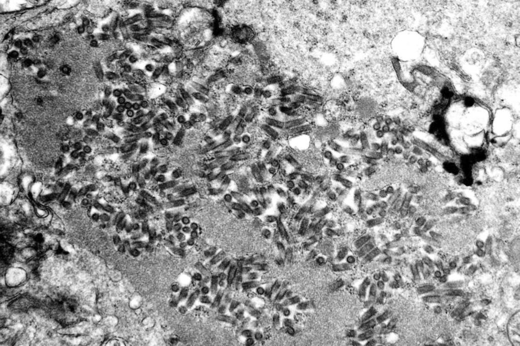 Organų transplantacijos pacientas Mičigane miršta nuo pasiutligės