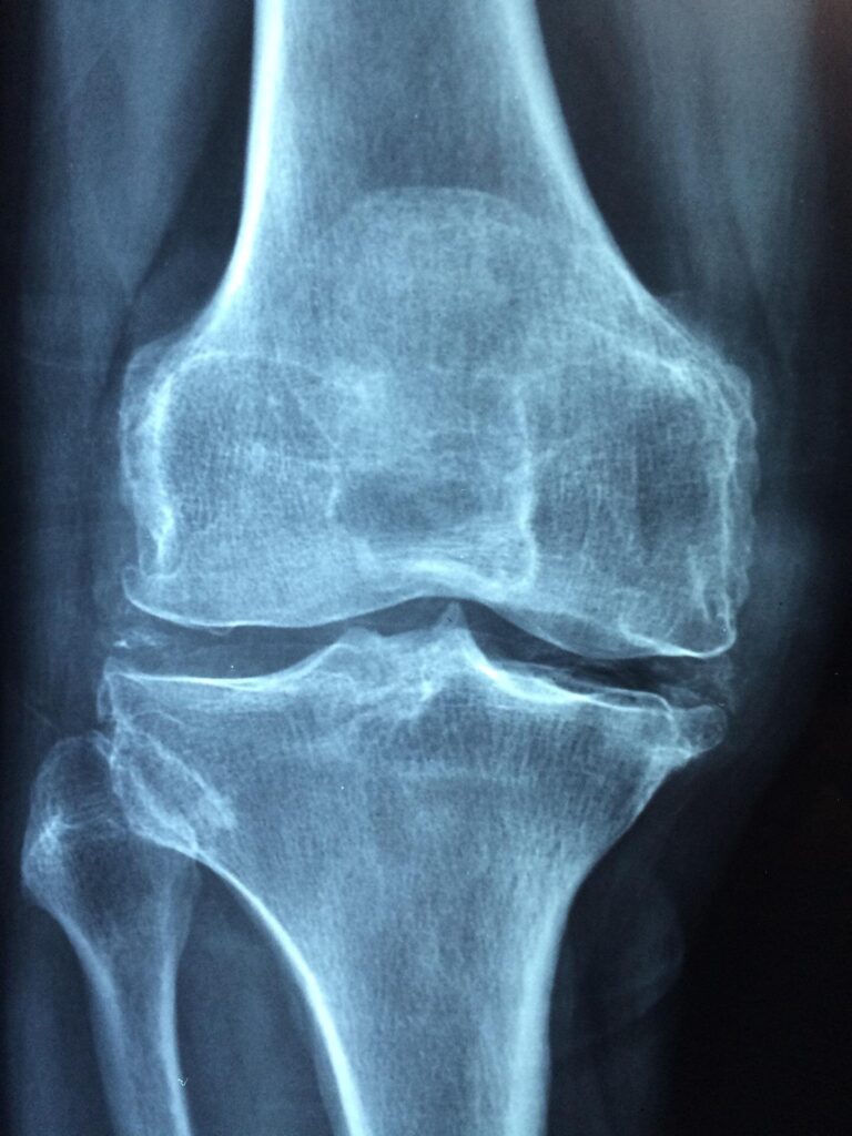 Bendras sutarimas pabrėžia kaulų apyvartos žymenų vaidmenį diagnozuojant osteoporozę ir valdymą