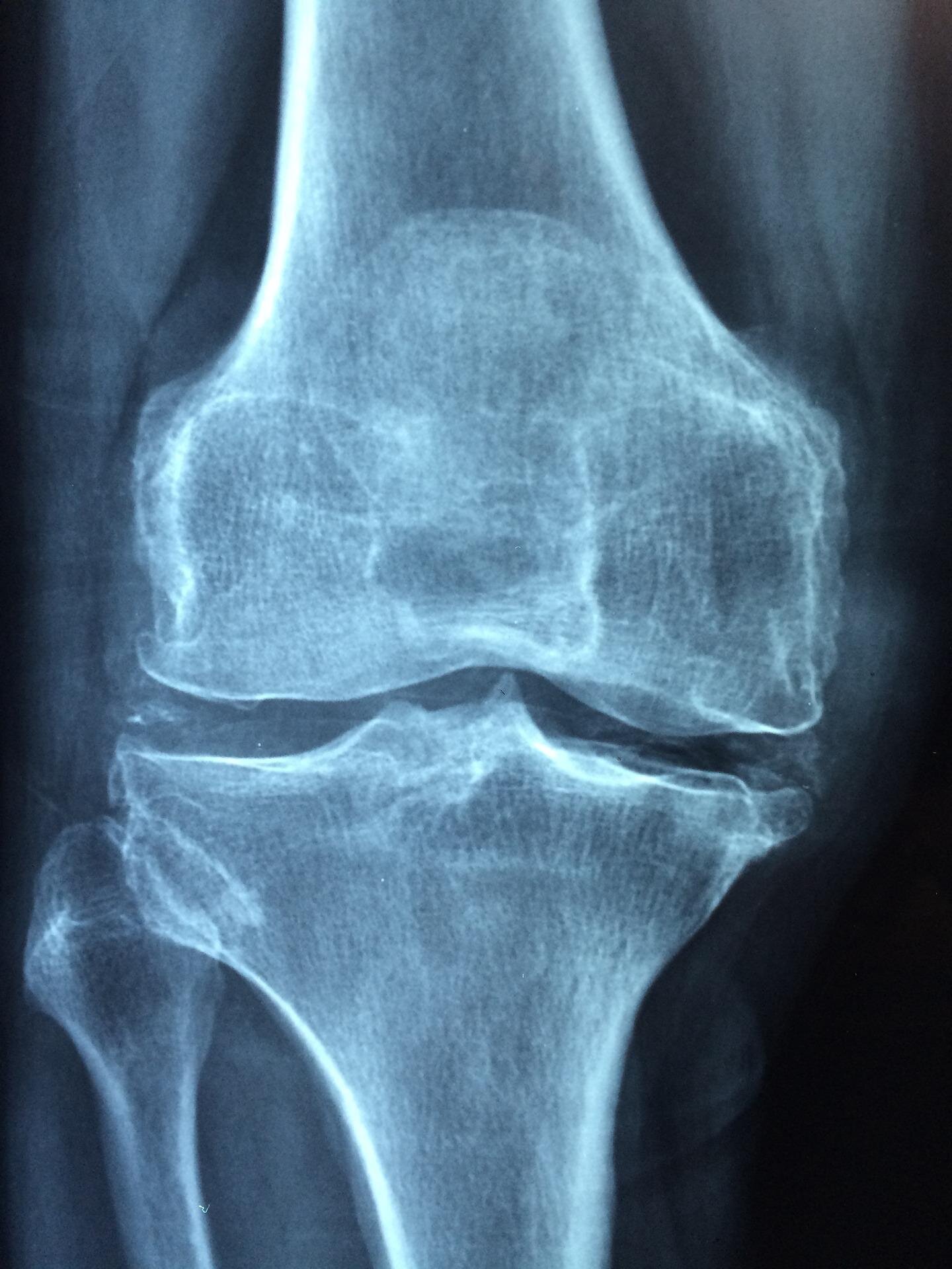 Bendras sutarimas pabrėžia kaulų apyvartos žymenų vaidmenį diagnozuojant osteoporozę ir valdymą