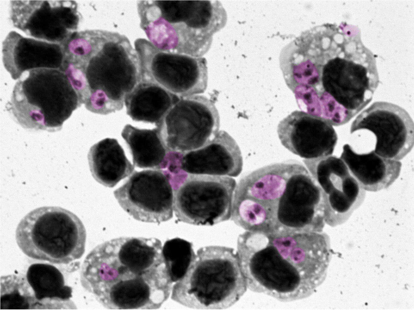 Biomarkeriai padeda numatyti parazitinės odos ligos gydymo sėkmę
