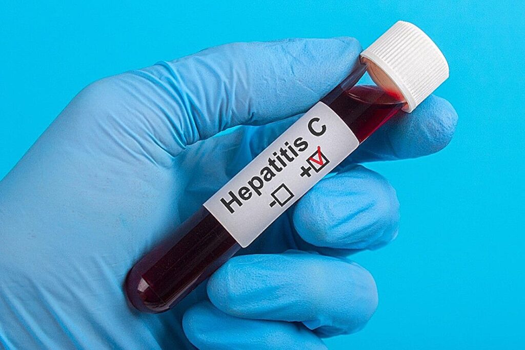 Skirtumai, nustatyti ryšyje su vaikų, sergančių hepatitu C, priežiūra