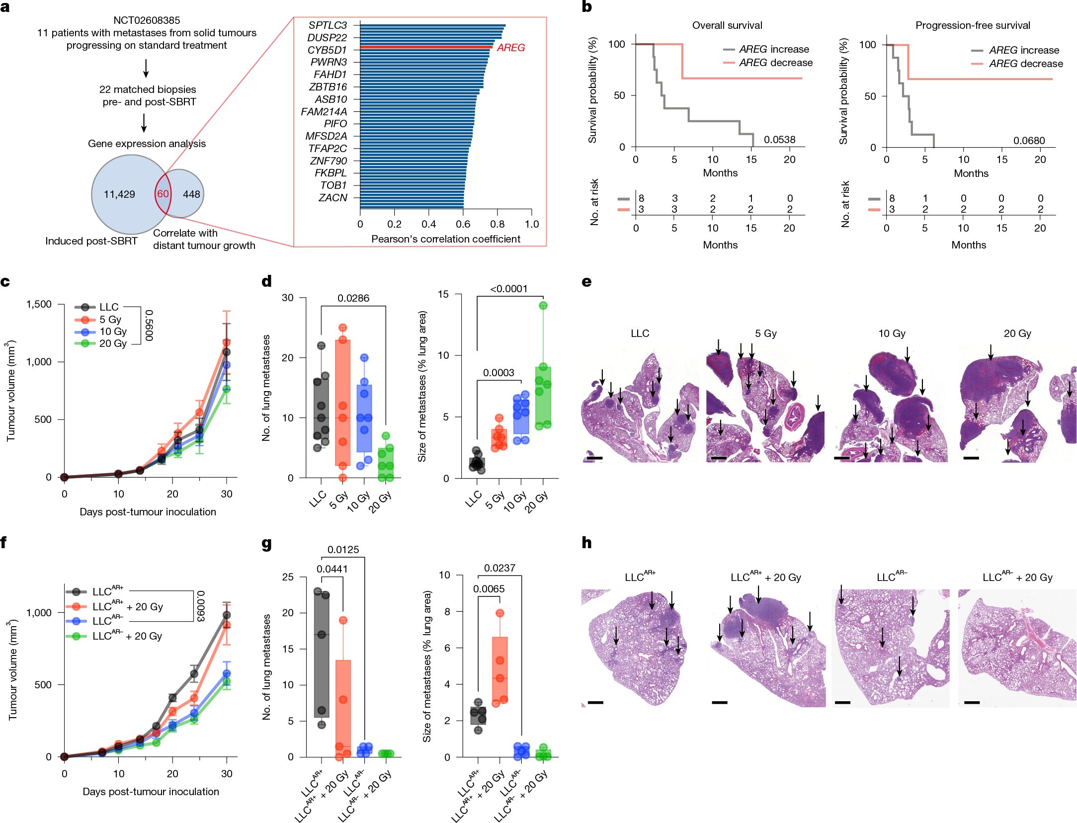 Didelės dozės radiacijos terapija gali paskatinti neapdorotų metastazavusių navikų augimą