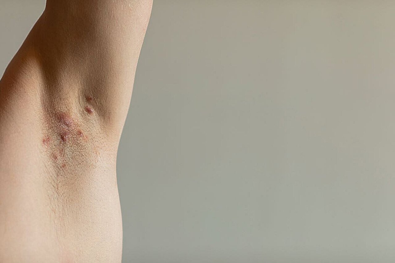 Socialinė ir ekonominė būklė, susijusi su nauja hidradenito suppurativa diagnoze