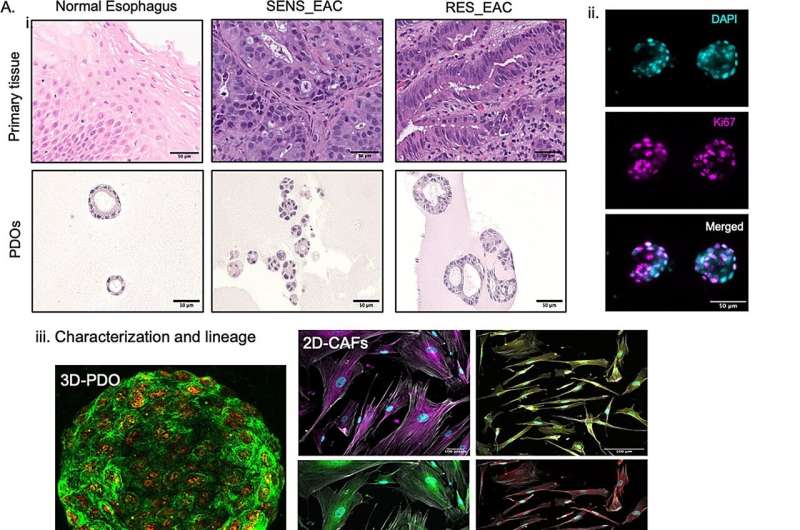 Tiksli onkologijos organų lustų platforma tiksliai ir veikiančiai prognozuoja pacientų, kenčiančių nuo stemplės adenokarcinomos, chemoterapijos atsakas