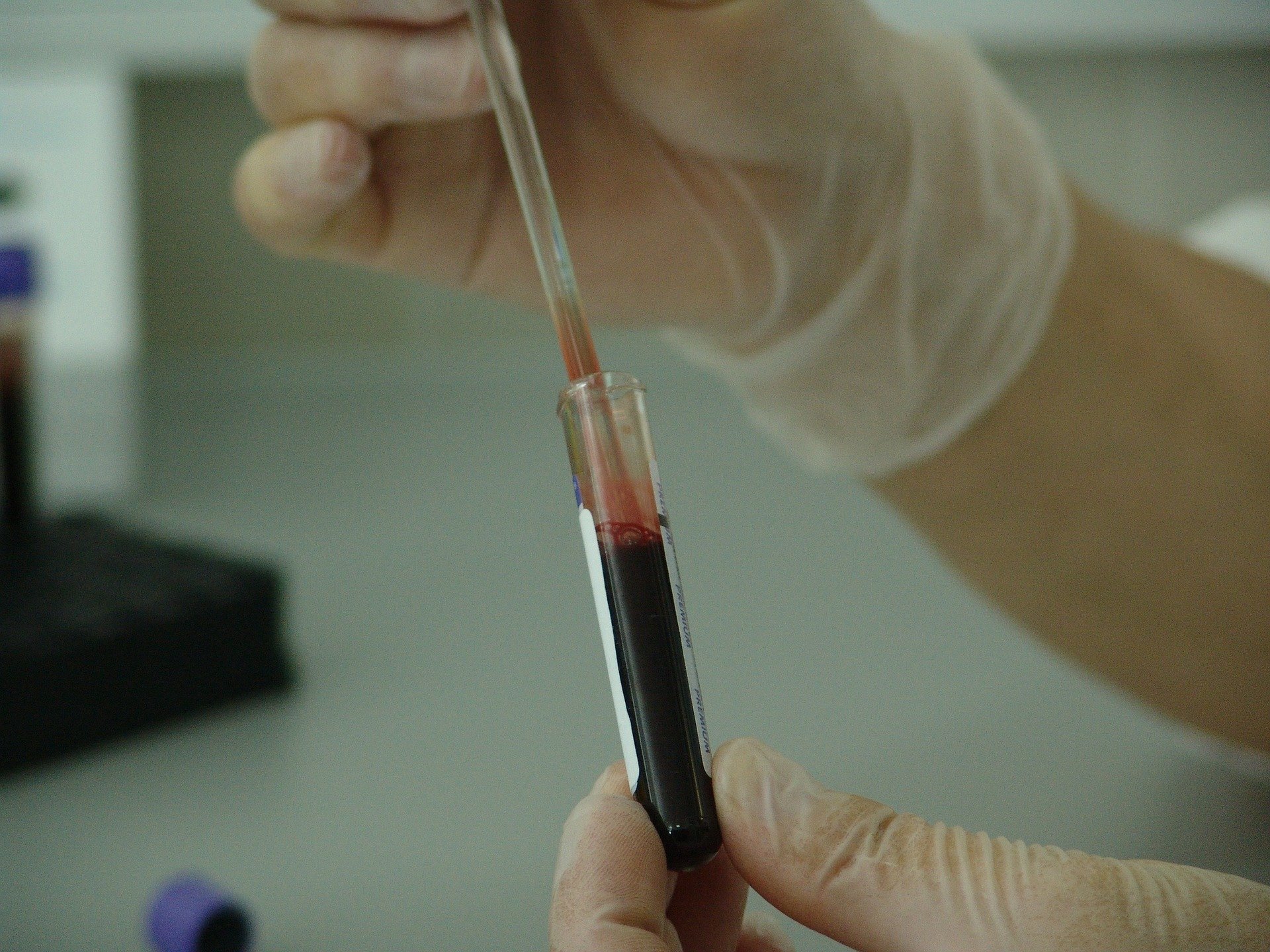 Pirmojo trimestro kraujo tyrimas žymiai pagerina nėštumo diabeto prognozę, tyrimo radiniai