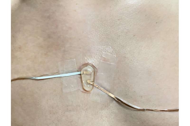 Jutiklis, kuris mankštos metu pritvirtintas tiesiai prie tiriamojo krūtinės, renka ir matuoja chlorido jonus prakaito mėginiuose. Tada šie lygiai yra nubraižyti realiu laiku naudojant kompiuterio programinę įrangą. Kreditas: pateikė „Wanqing Zhang“. Prakaito laužymas: chlorido naudojimas prakaitu, kad padėtų diagnozuoti cistinę fibrozę