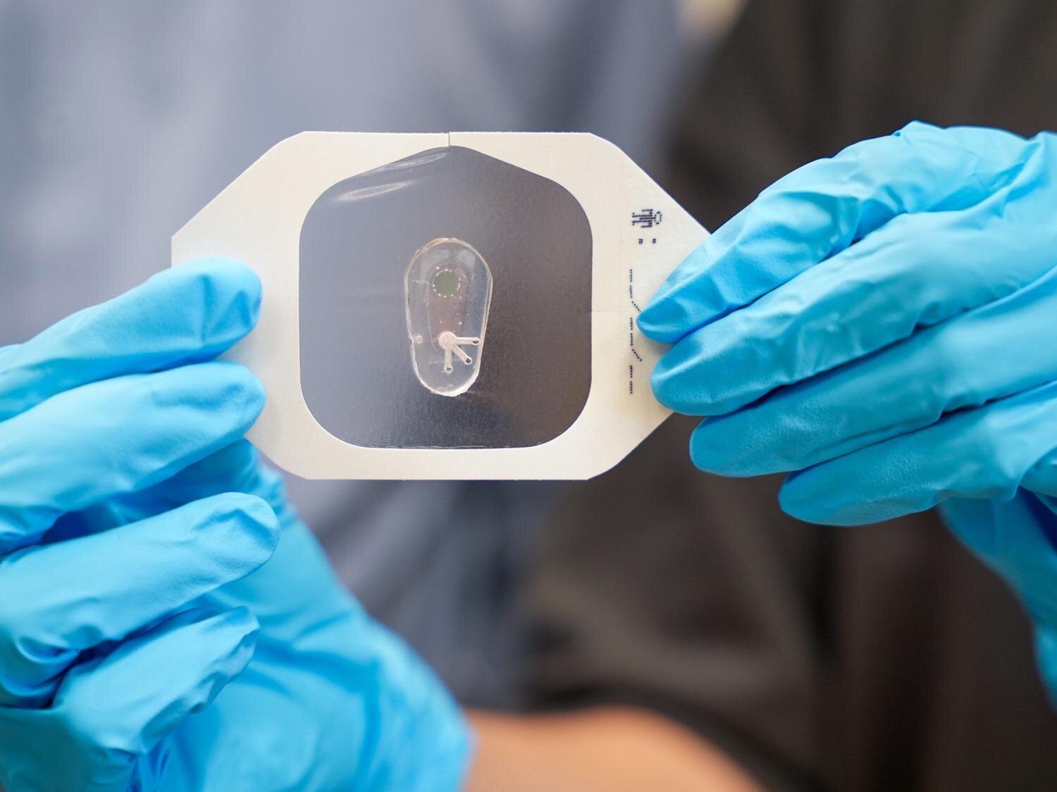 Chlorido naudojimas prakaitu, kad padėtų diagnozuoti cistinę fibrozę