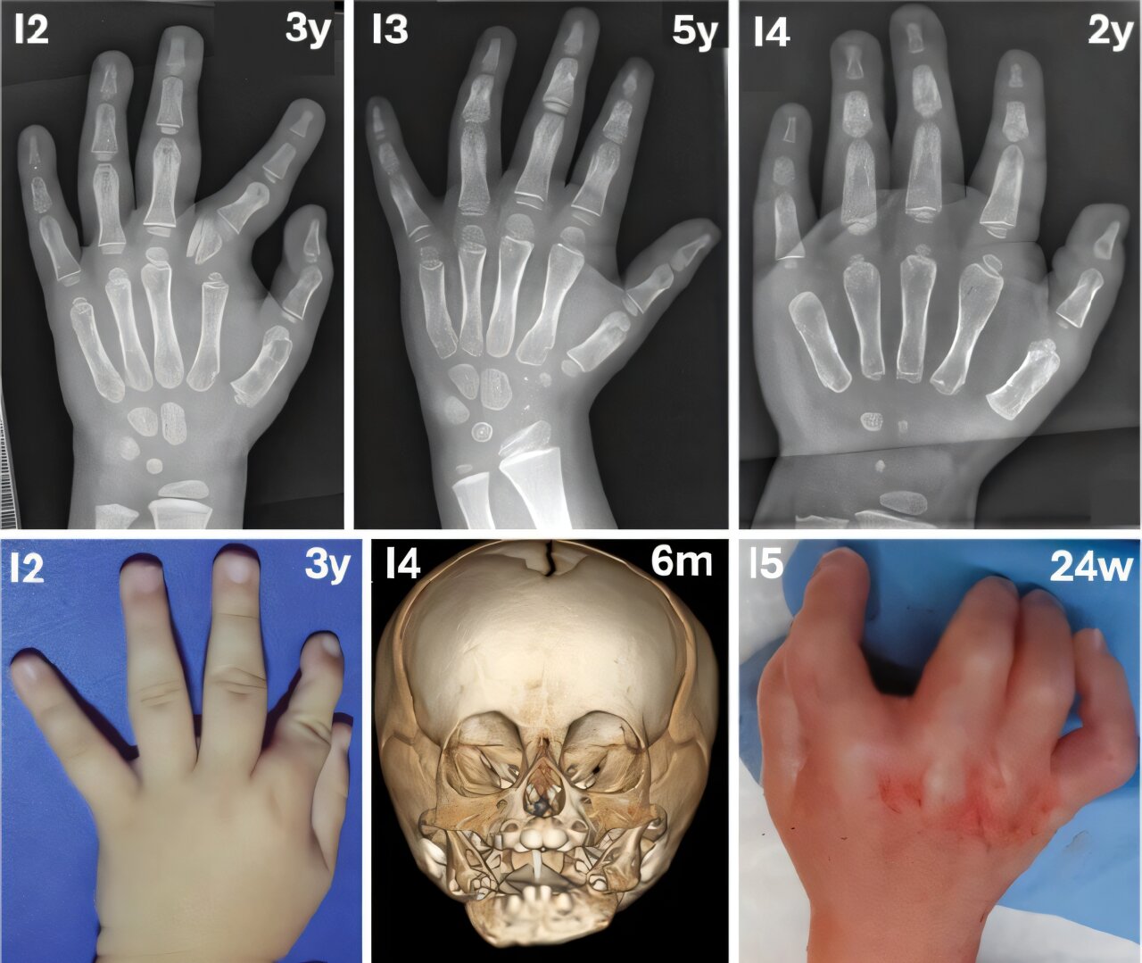 Retas kaulų sutrikimas atsirado dėl „fermento gelbėjimo metabolito“ trūkumo naujame tyrime