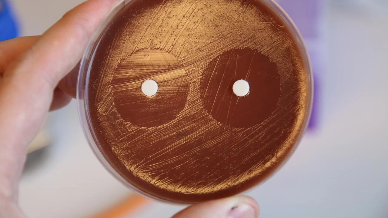 Gonorėjos atvejai padidėja, nes atsparumas antibiotikams riboja gydymo galimybes