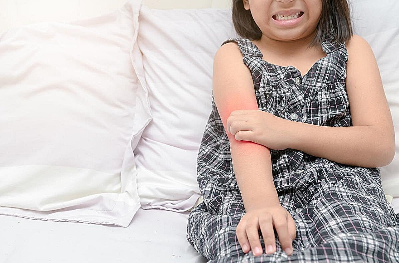 FDA patvirtina opzelura dėl atopinio dermatito vaikams