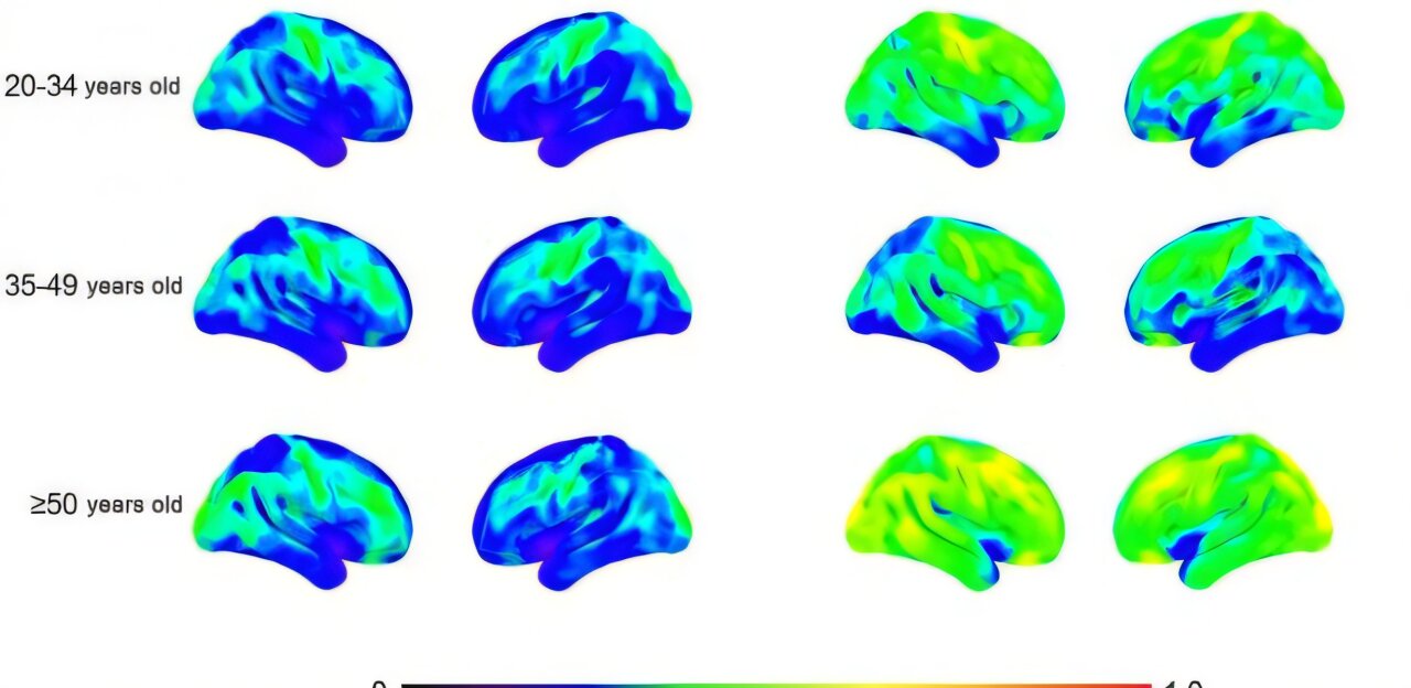 Ankstyvasis neuroinfekcija žmonėms, sergantiems Dauno sindromu, gali paaiškinti didelį Alzheimerio ligos paplitimą