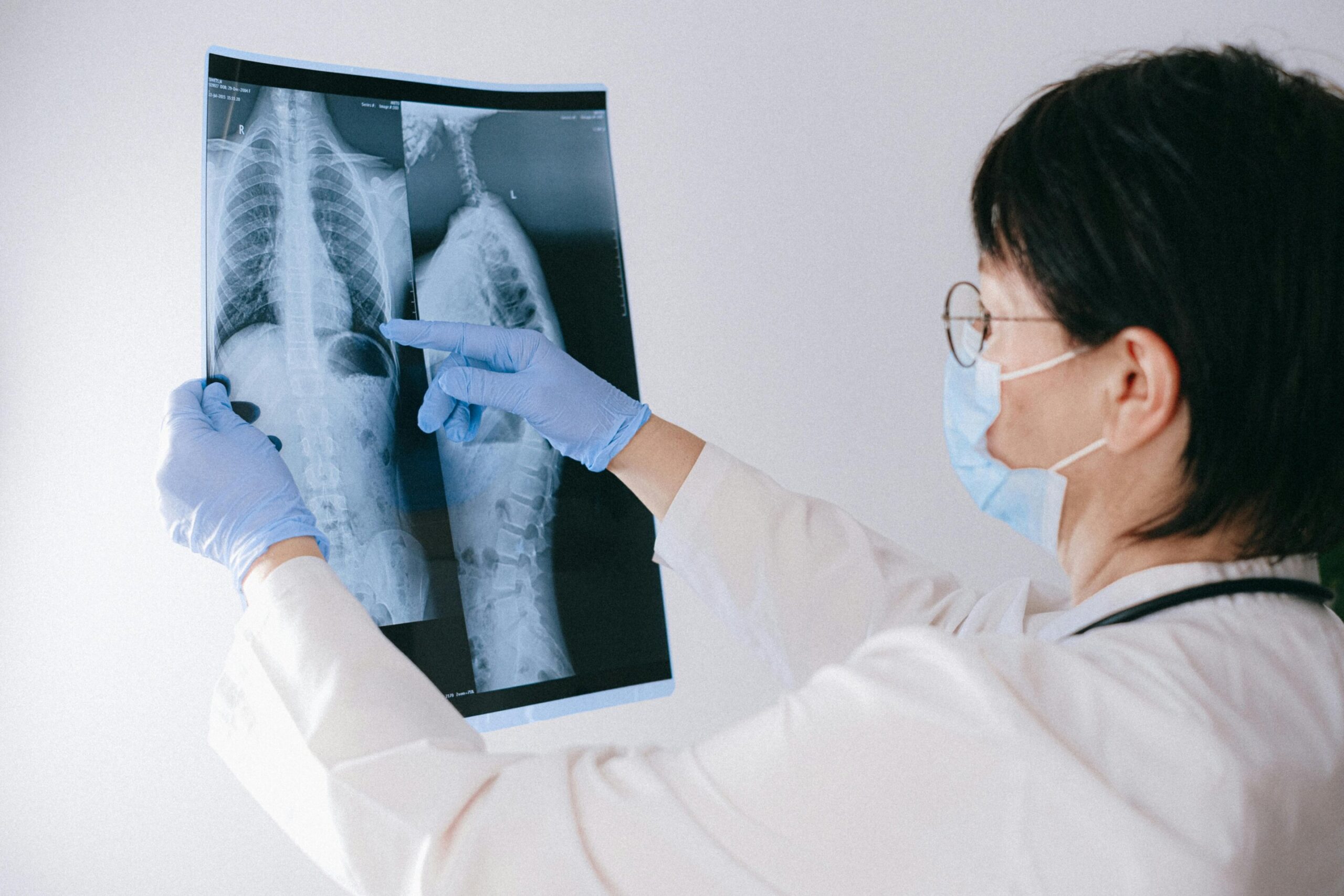 Tikslinis steroidų vartojimas gali pasiūlyti visuotinį papildomą gydymą kovai su TB