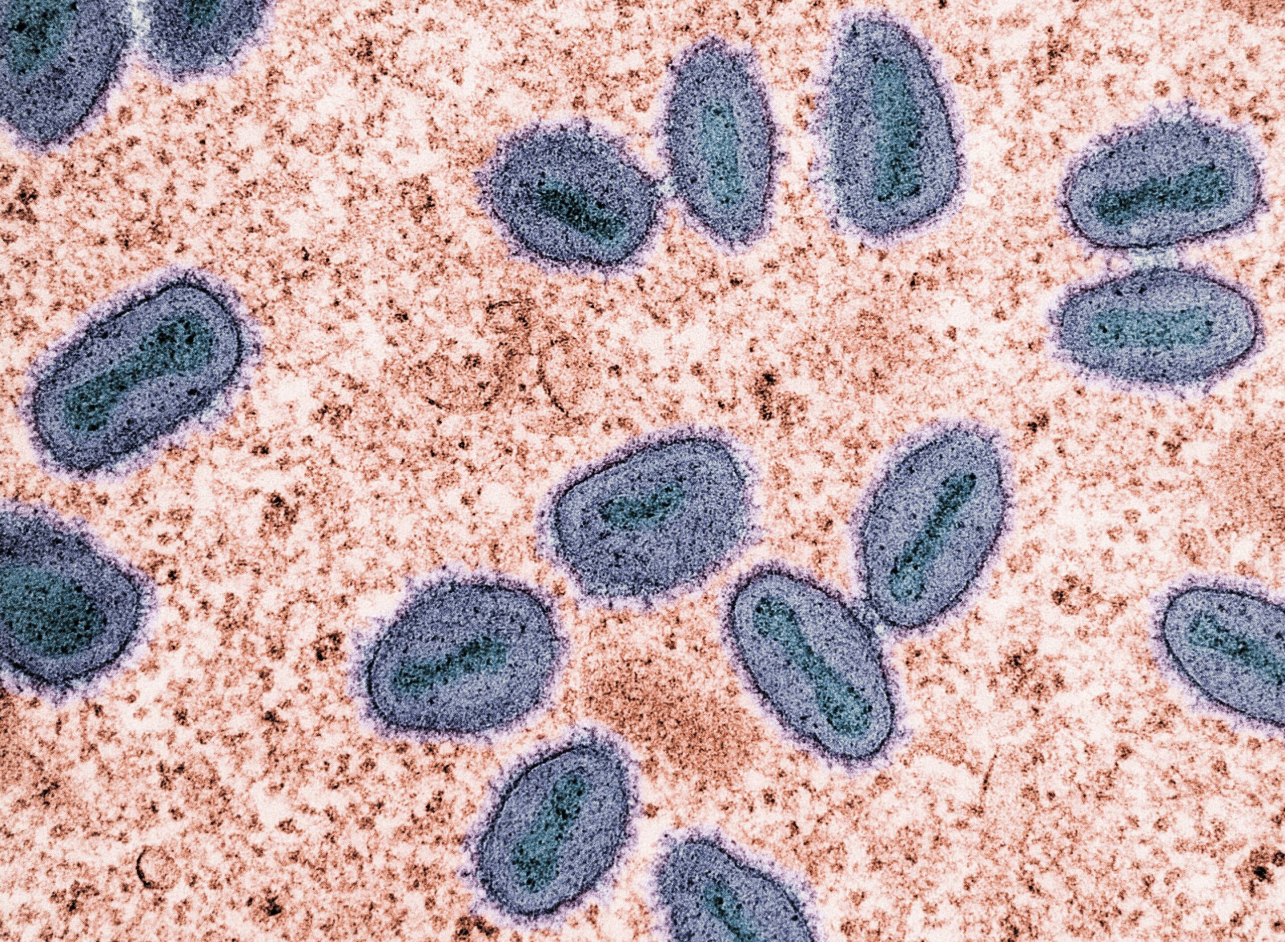 Mpox padermė, kuri gali būti sunkesnė ir lengvai plintanti, pirmą kartą aptinkama LA apygardoje