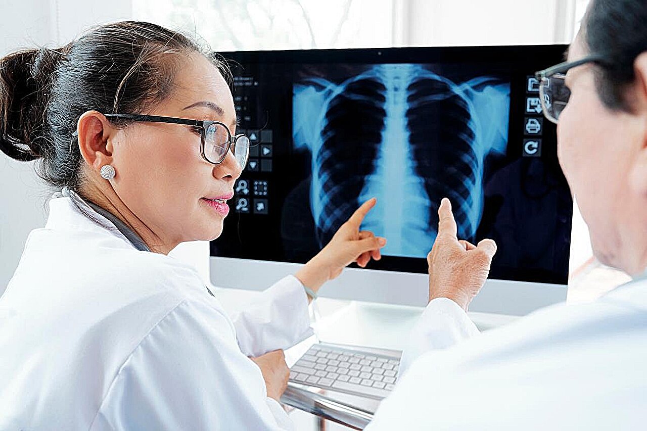 SGLT2 inhibitoriai gali sulėtinti mazgų augimą sergant plaučių piktybiniais navikais