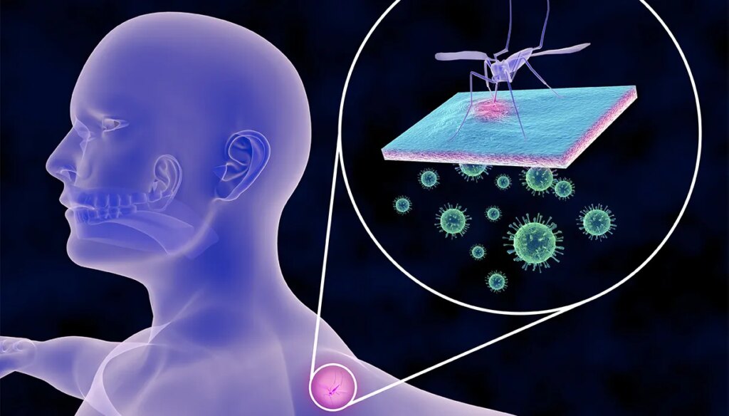 Chikungunya, yra vakcina: kam jos reikia, kaip ji veikia, prieš kokias keliones nurodoma