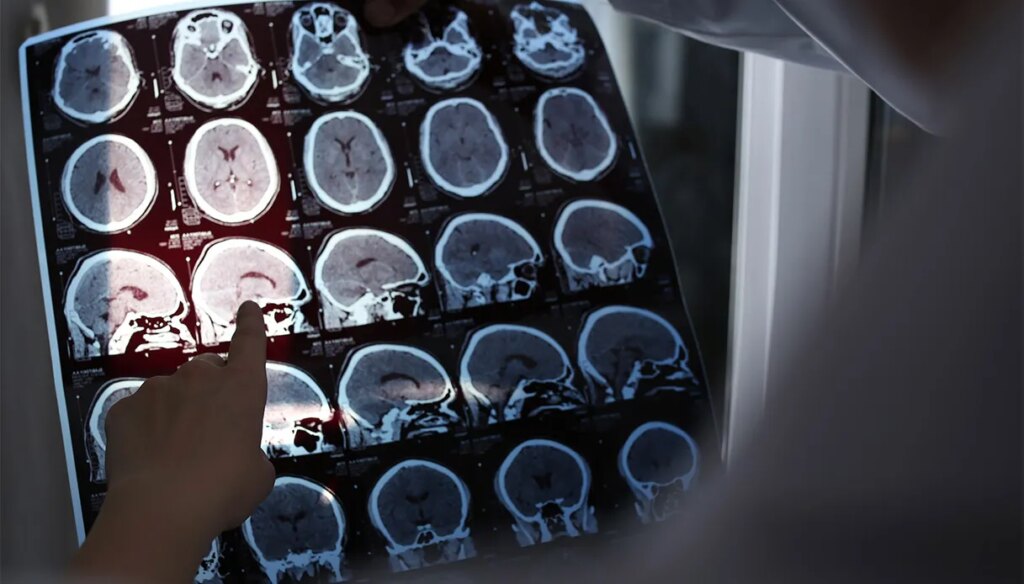 Gliomos ir smegenų augliai, kaip gydymas keičiasi naudojant tiksliąją mediciną