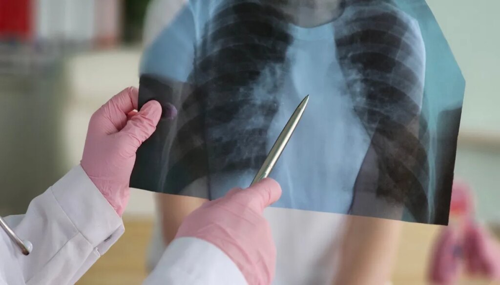 Trieste tuberkuliozės pavojaus signalas, teigiama 30 studentų. Ekspertų patikinimai, rizika ir vakcinacija